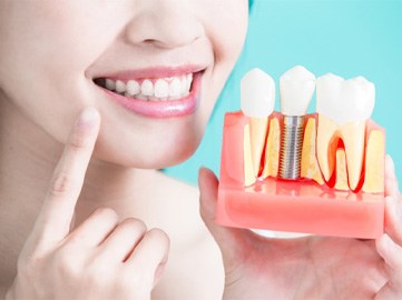 Closeup of Norwood implant dentist holding a model of dental implants and pointing to her teeth