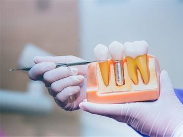 a dentist holding a model of dental implants
