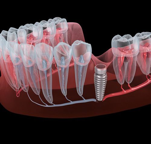 Dental implant placed in gum tissue