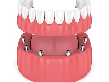 Model of lower implant-retained denture