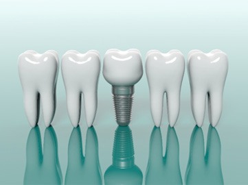 Digital models of teeth and a dental implant in Norwood next to each other