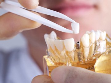 Closeup of Norwood dentist placing a restoration on a dental implant model