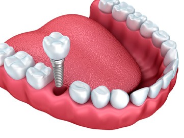 Digital illustration of a single tooth dental implant in Norwood