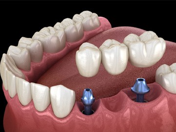 Digital illustration of an implant bridge replacing multiple missing teeth in Norwood