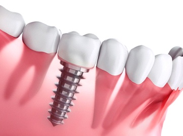 dental implant in Norwood