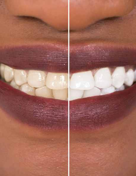 Patient's smile before and after teeth whitening