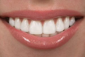 porcelain veneers