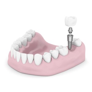 dental implants FTW!