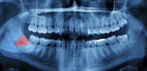 Wisdom teeth removal at Central Dental Associates is carefully considered and planned by our dentists. 