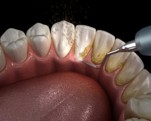 high definition picture of plaque removal
