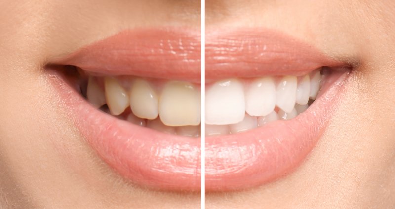 Woman before and after teeth whitening