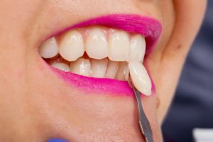 Close up of a veneer next to a woman’s tooth