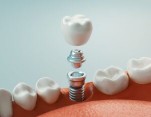 Dental implant rendering. 